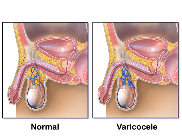 Illustration for article titled Obat Varikokel Yang Ampuh